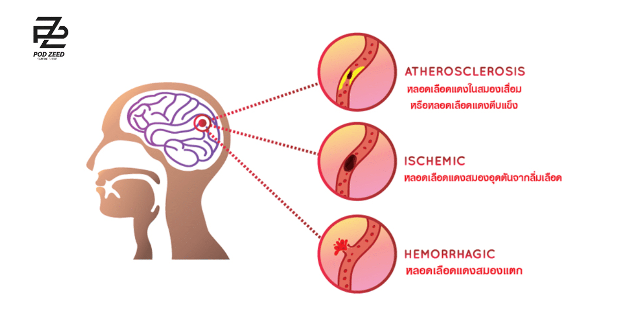 Risk of blood clots in the brain